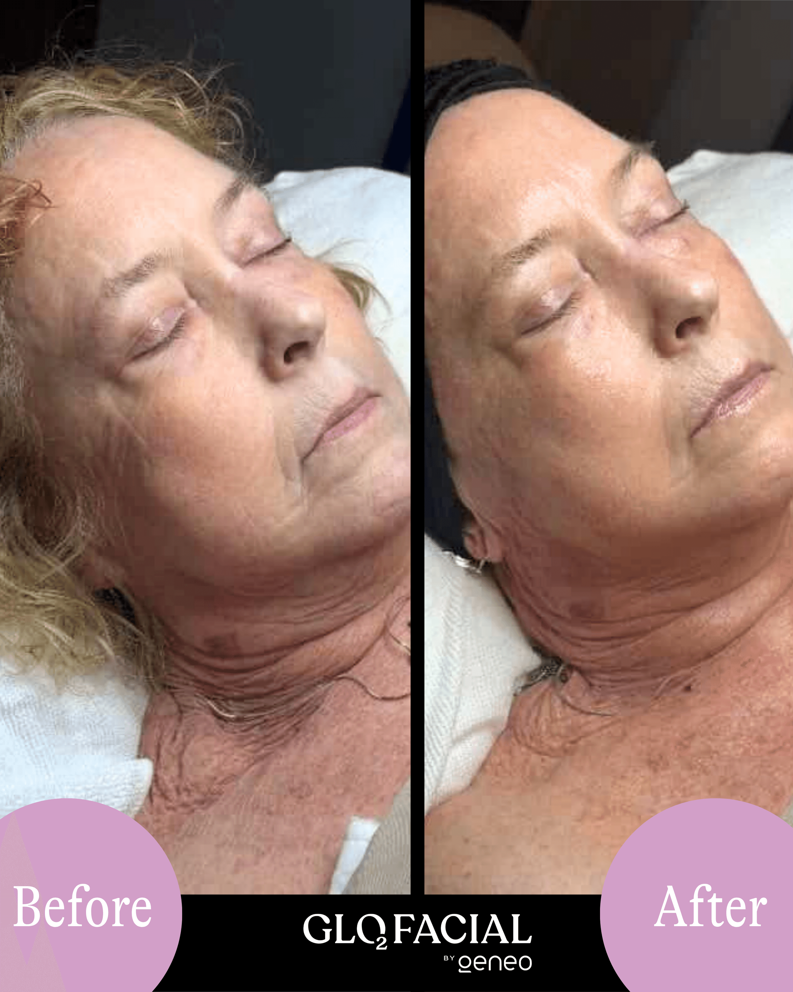 Glo2Facial before and after result showing improved skin radiance