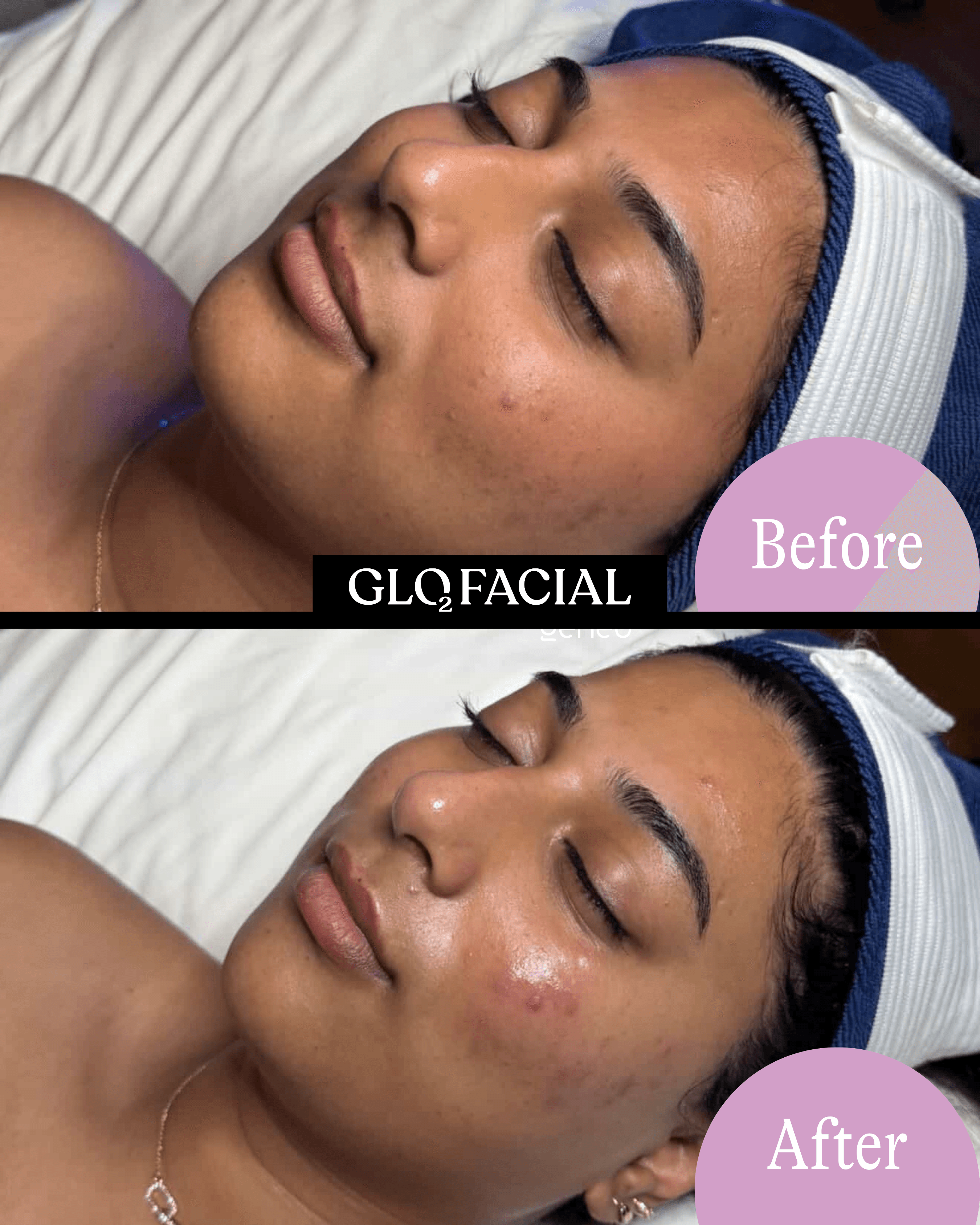 Glo2Facial before and after result showing improved skin clarity