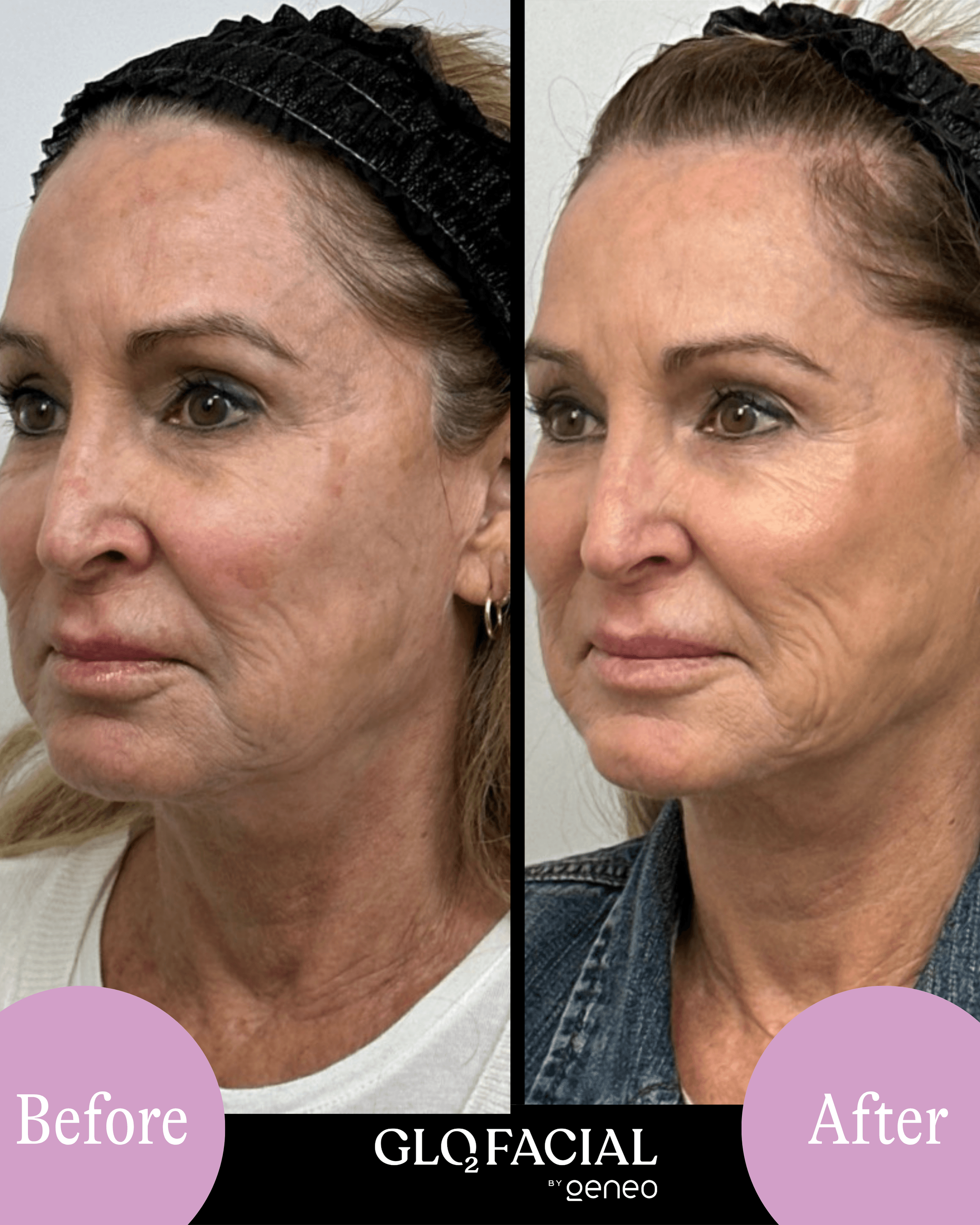 Glo2Facial before and after result showing smoother-looking skin