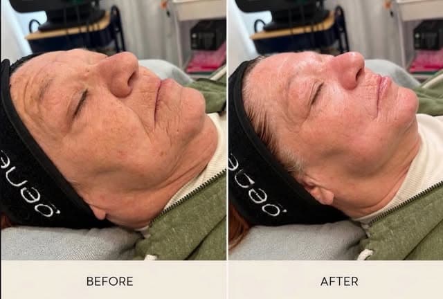 Glo2Facial before and after result
