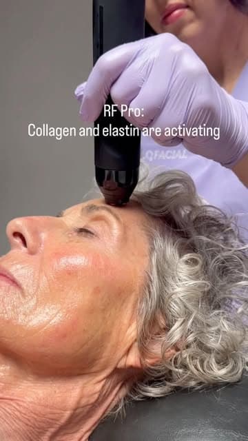 Glo2Facial RF Pro treatment reel