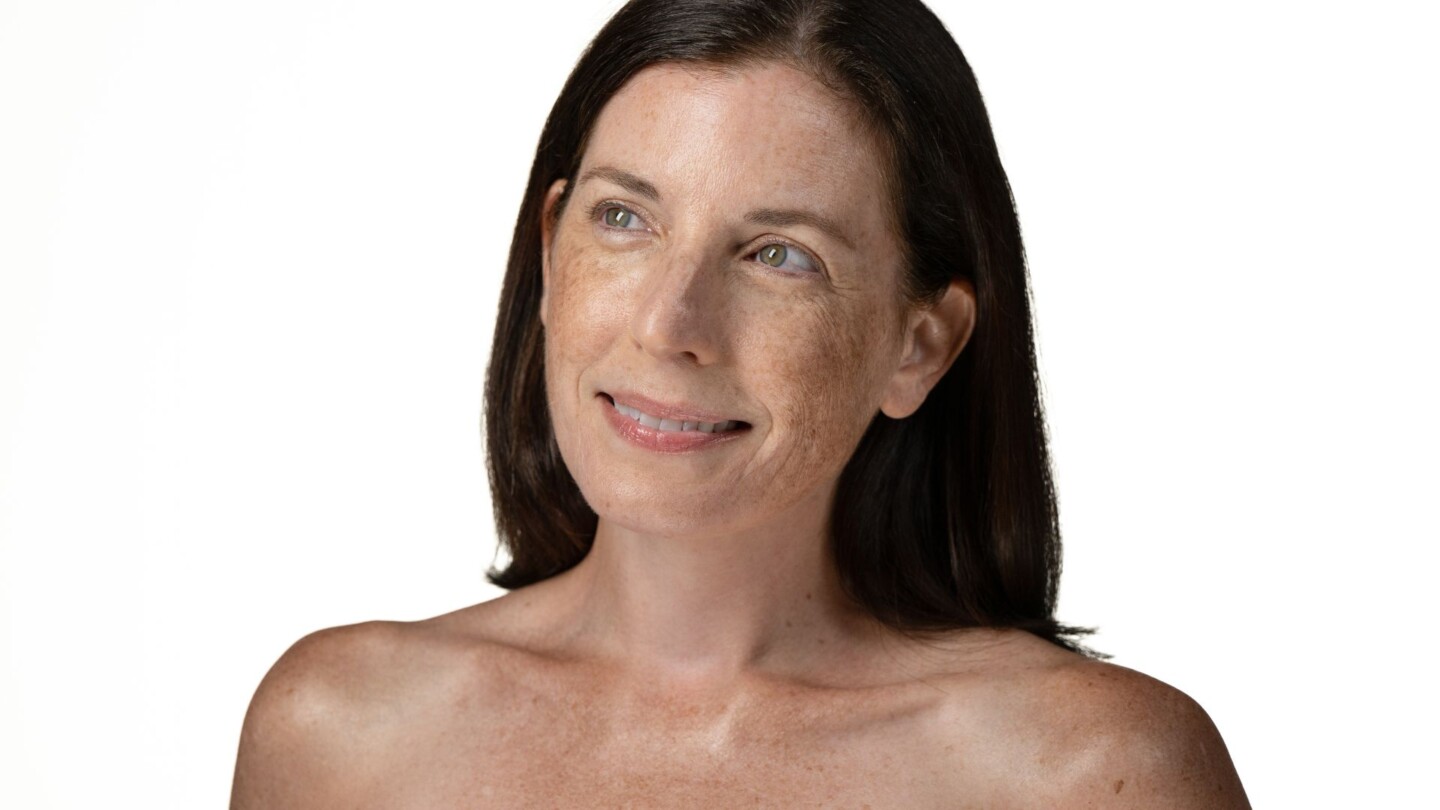 Woman with sun damaged skin after receiving skin care for sun damaged skin