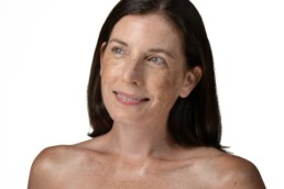 Woman with sun damaged skin after receiving skin care for sun damaged skin